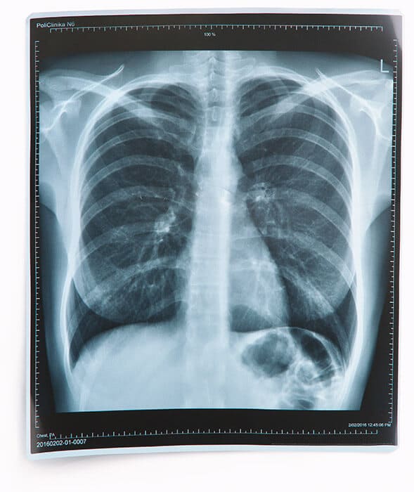 X-ray symbol representing personalized disease prevention advice from DNA test results
